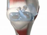 10 természetes módszer, amellyel enyhíthető a reumás ízületi gyulladás