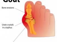 Hatékonyan kezelhető-e az ananásszal a köszvény?